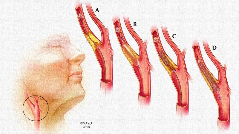 Καρωτιδική Νόσος: Αγγειοπλαστική - Stent