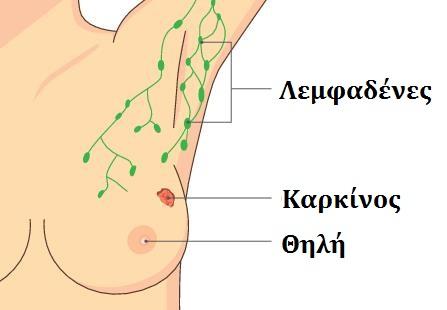 Breast Cancer Lymphnodes Greek