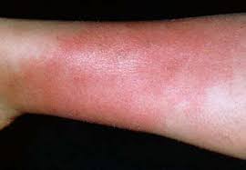 Leg Cellulitis
