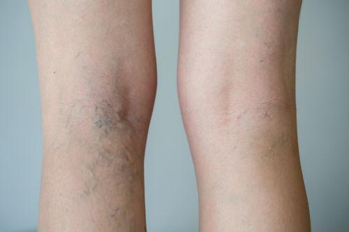 Varicose Veins