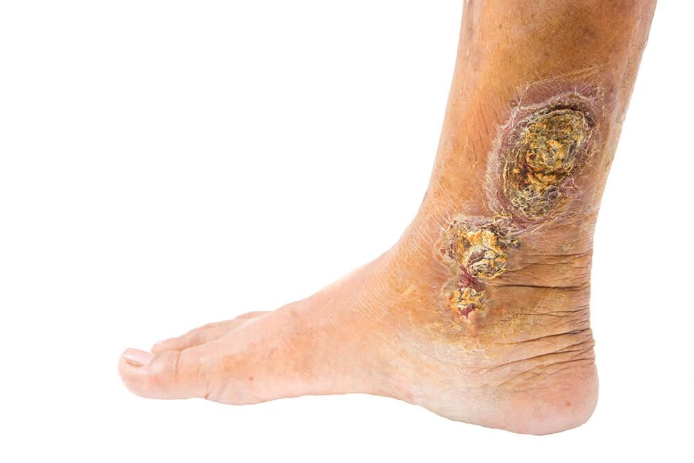 Leg Ulcer 215050180