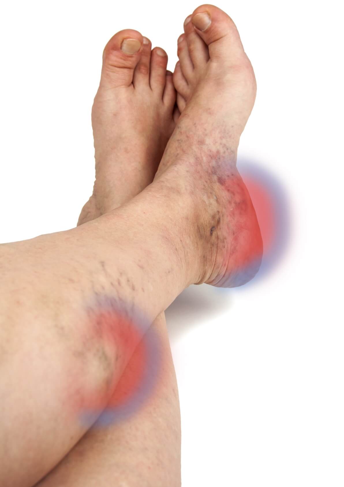 Varicose Veins 201145265