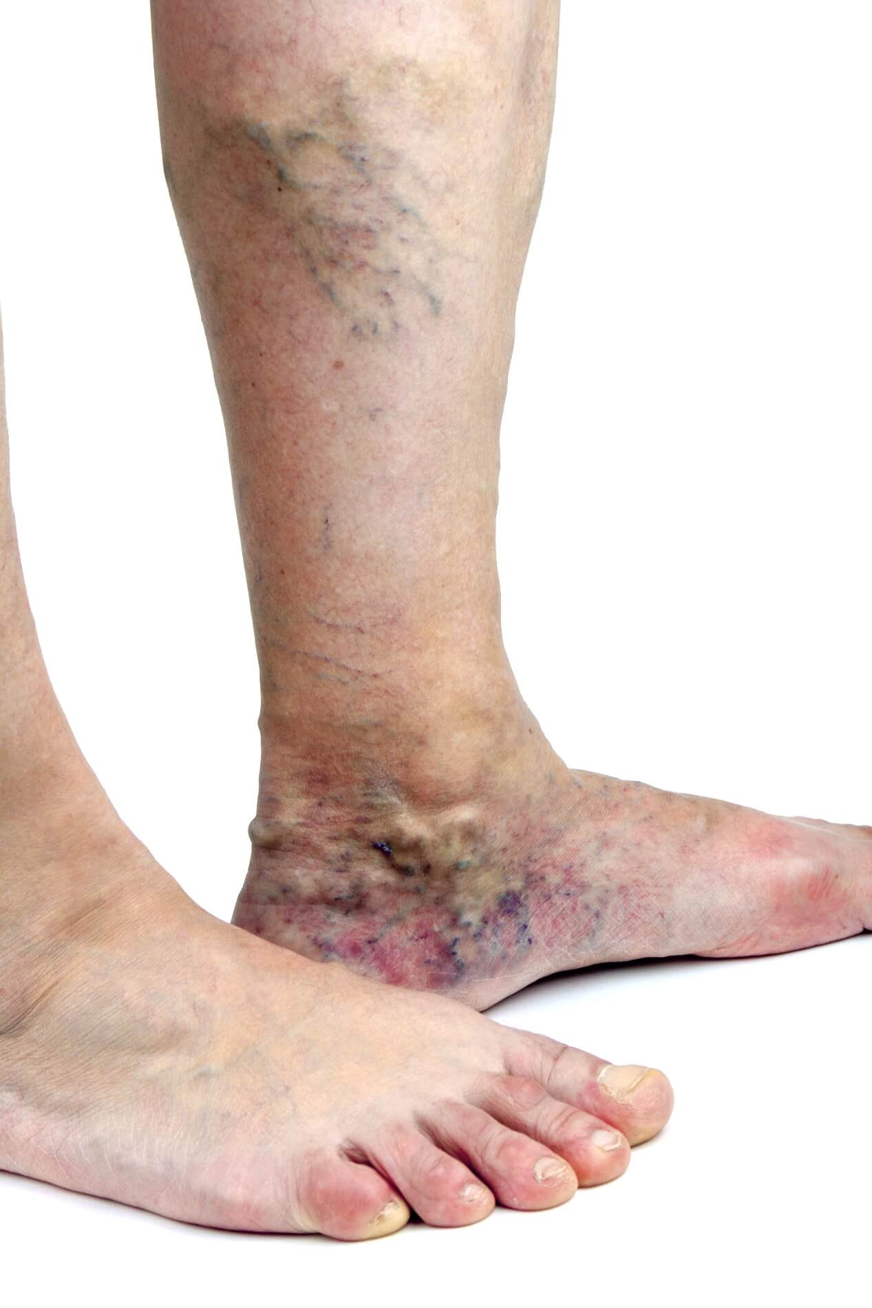 varicose veins PTS 195602750