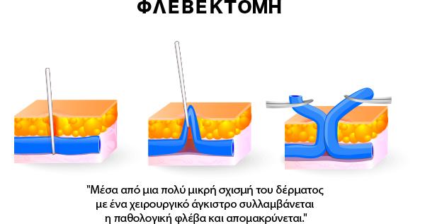 Mini Φλεβεκτομές