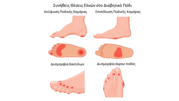 Τι είναι το Διαβητικό Πόδι